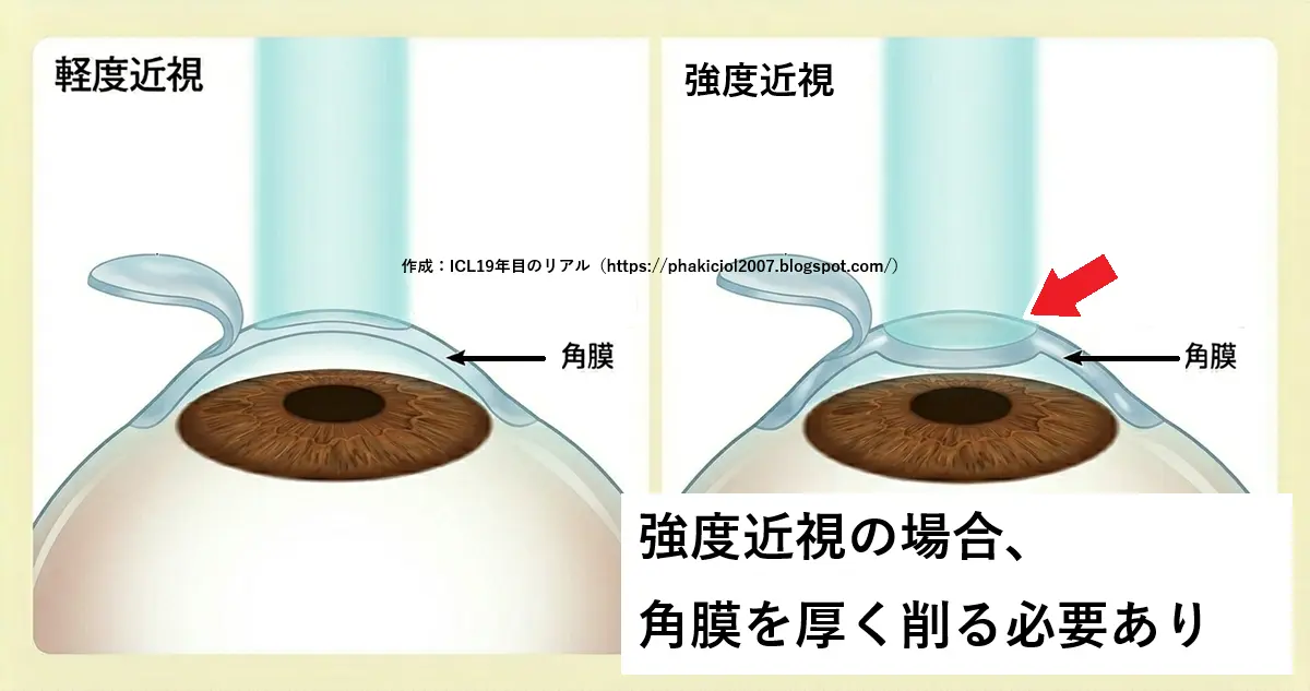 レーシックの仕組みと最強度近視|ICL術後19年目のリアル